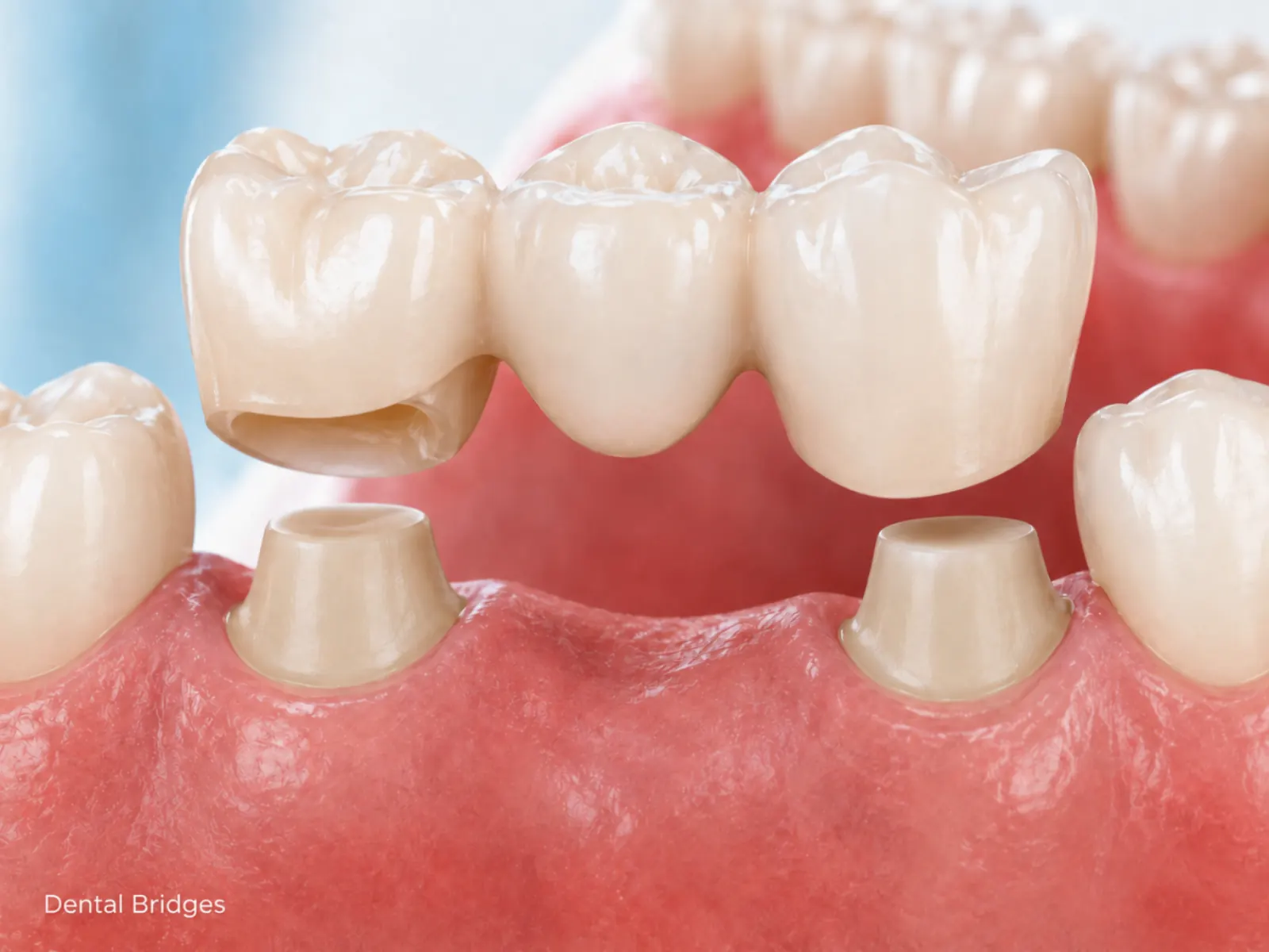 Dental bridges dental treatment at a Mexican clinic