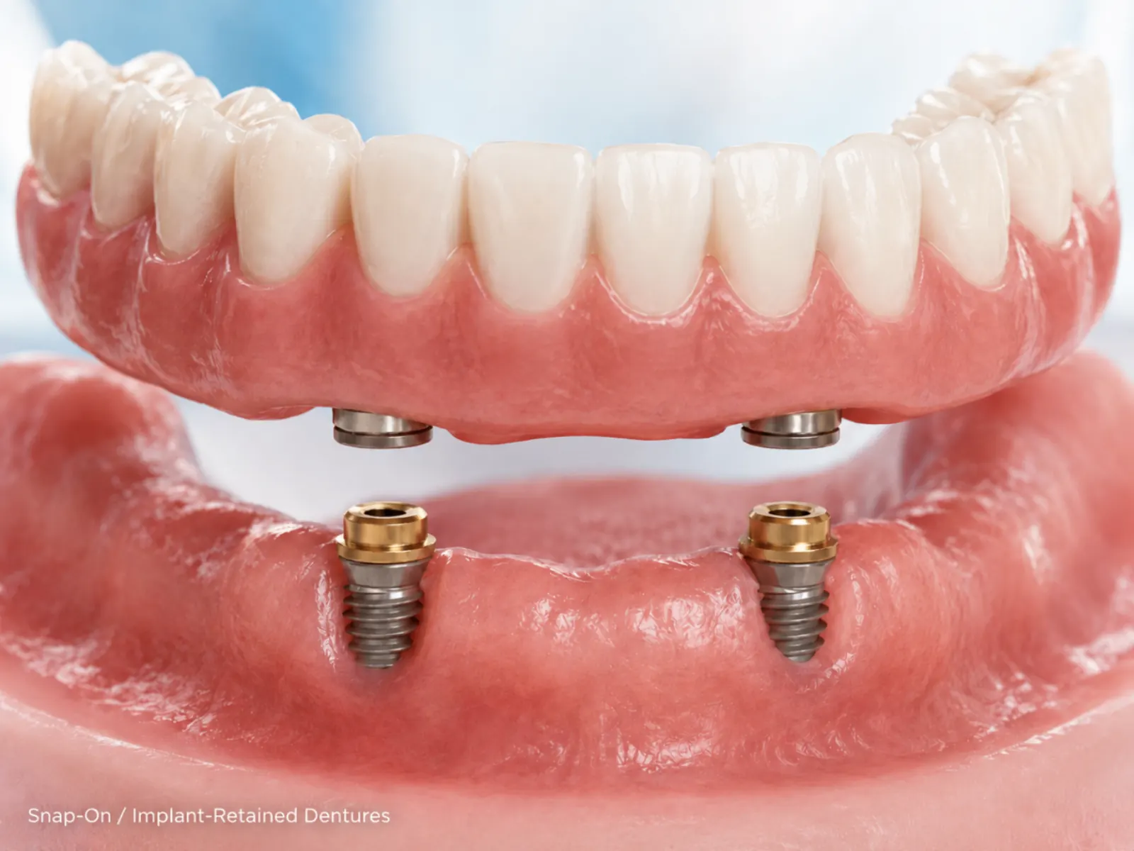 Snap-on / implant-retained dentures dental treatment at a Mexican clinic